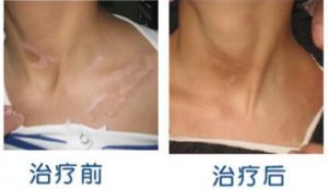 白癜风的危害有哪些?