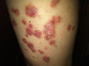 牛皮癣患者治愈消除症状后多久会再次复发呢?