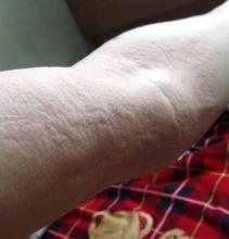 荨麻疹传染人不?