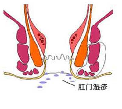 肛周部位出现湿疹都是什么原因诱发的呢?