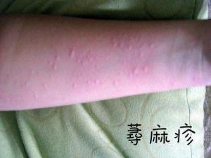 荨麻疹的症状损害为什么会在夜间特别明显呢?